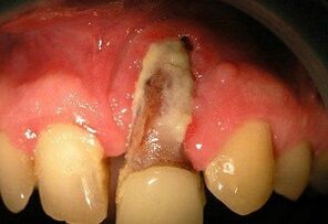 Ostéomyélite après extraction des dents